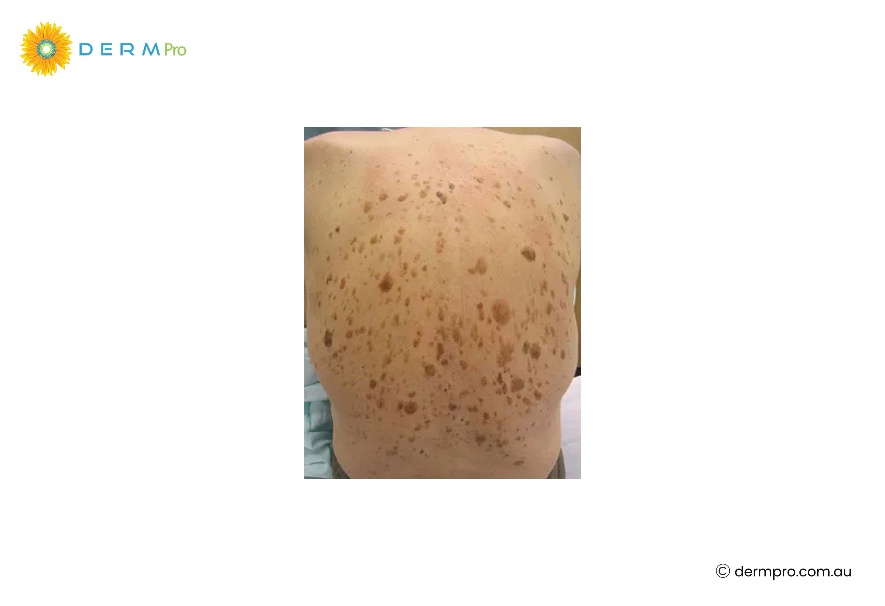 Image of Seborrheic Keratosis